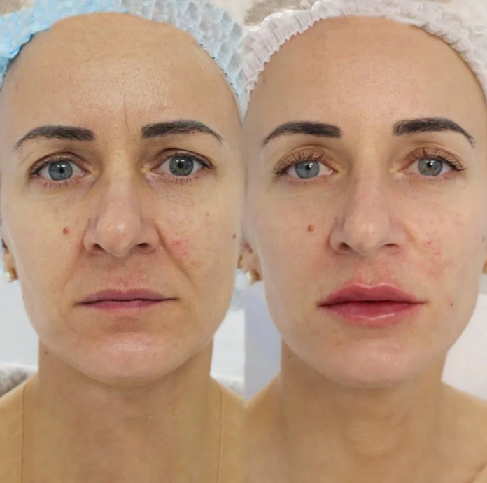 revanesse dermal filler