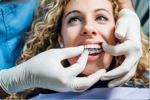 Invisalign underbite